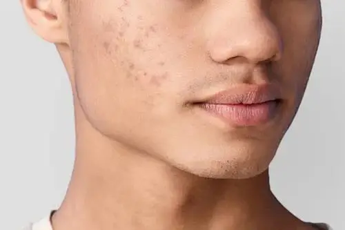 Thâm mụn là gì? Bao lâu thì hết? Nguyên nhân và cách trị